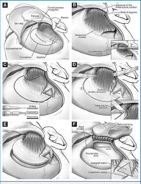 Figure 2 from Osteoplastic Pterional Craniotomy Revisited | Semantic Scholar