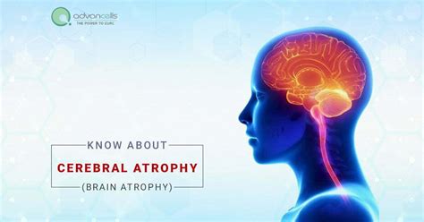 Brain or Cerebral Atrophy: Causes, Symptoms, Diagnosis & Treatment