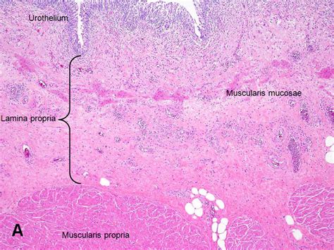 American Urological Association - Urinary Bladder: Muscularis Propria