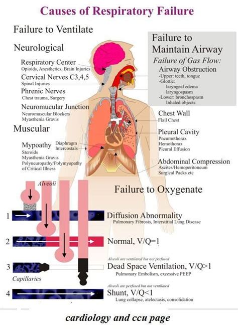 Diagnosis For Acute Respiratory Failure Acute Respiratory Failure ...