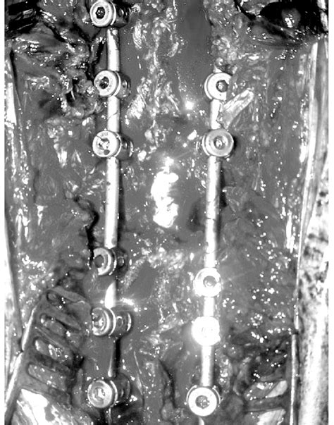 Intraoperative view of the osteotomy site after posterior instrumentation. | Download Scientific ...