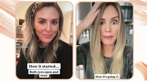 Botox injections gone wrong, influencer left with drooping eyelid | Trending News - The Indian ...