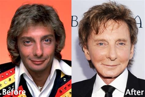 Barry Manilow Plastic Surgery Before and After