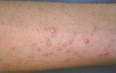 Follicular Eruption on Arms and Legs—Quiz Case | Dermatology | JAMA Dermatology | JAMA Network