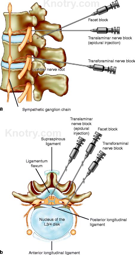 PDF] Cervical Transforaminal Epidural Steroid Injection, 53% OFF