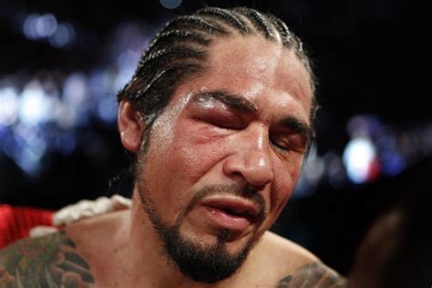 Miguel Cotto vs Antonio Margarito: Photos of the Swollen Eye | IBTimes