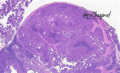 Case 9: Acinic Cell Carcinoma