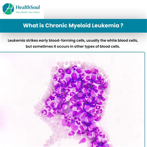 Chronic Myeloid Leukemia: Symptoms and Treatment – Healthsoul