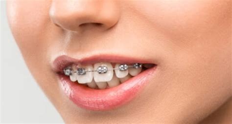 How to Fix an Overbite with Braces? - Transits Blog