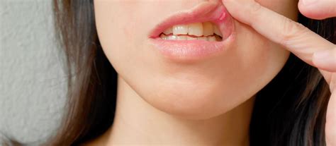 Llagas en la boca: Causas y Remedios - Dentista Girona - CESADEN