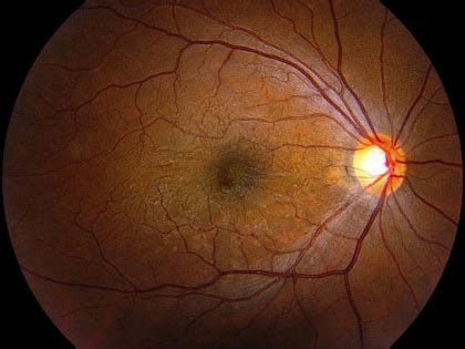 Local Epiretinal Membrane & Macular Pucker Treatment