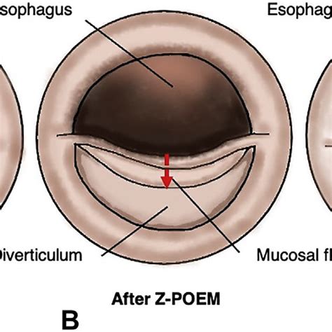 Traditional flexible endoscopic cricopharyngeal myotomy. A, The septum ...