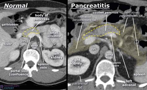 CT abdomen general