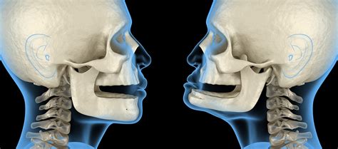 Jaw Bone Loss & Deterioration - Provincial Oral Surgery