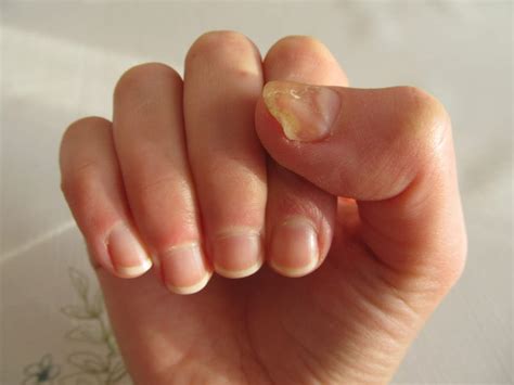 Yellow Nails: What causes yellow nails and how to cure this problem