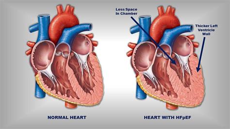 Research Story Tip: Obesity Weakens Heart Muscle in Patients with a Common Type of Heart Failure