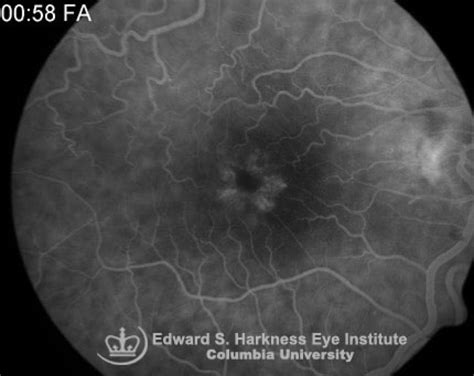 Cystoid Macular Edema | Vagelos College of Physicians and Surgeons