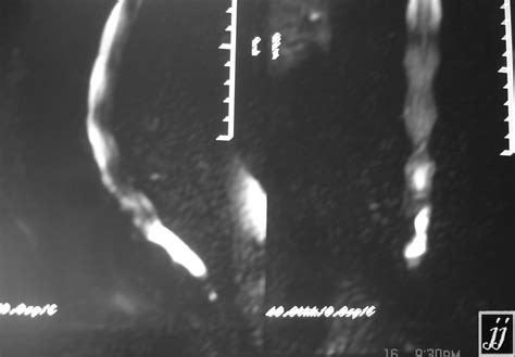 Intradural extramedullary tumor – Radiopaedia