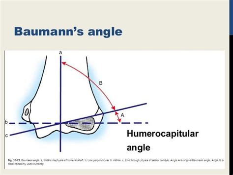 supra condylar fracture humerus