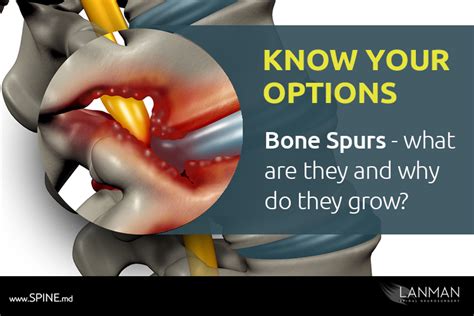 What are bone spurs and why do they grow? | Spine.MD