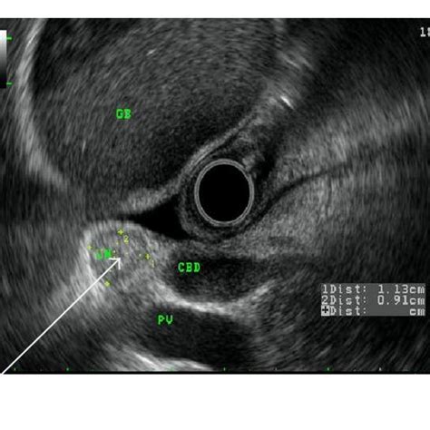 Endoscopic ultrasound images arrows showing (clockwise) (a) CBD... | Download Scientific Diagram