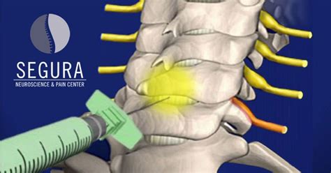 Cervical Epidural Steroid Injections - Segura Pain Center