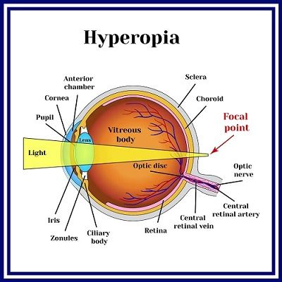 Hyperopia - Davis Eyecare