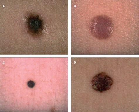 Figure 1 from Small Nodular Melanoma: The Beginning of a Life-Threatening Lesion. A Clinical ...