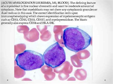 Department of Pathological Anatomy Acute myeloid leukemia Prepared