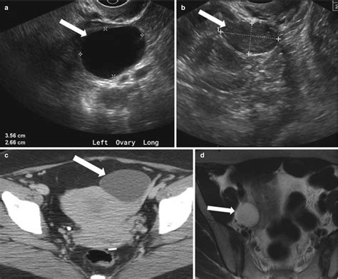 The Adnexa | Radiology Key