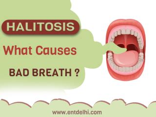 HALITOSIS - CAUSES OF BAD BREATH - Ent Delhi