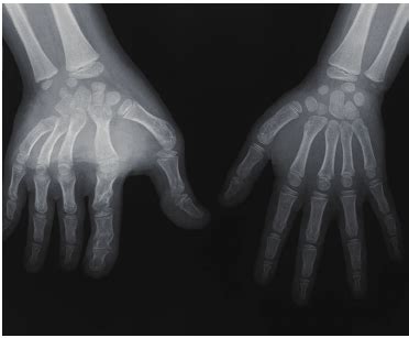 X-ray at age six, with correction of clinodactyly and epiphysiodesis ...