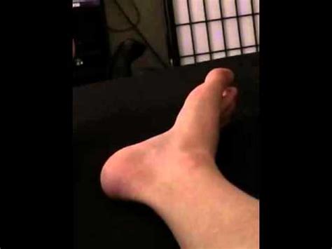 Foot fasciculations - YouTube