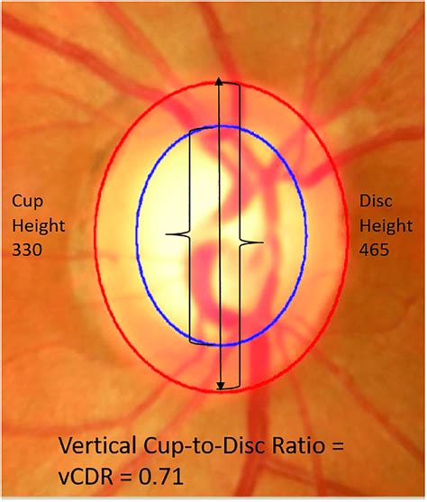 Increased Cup To Disc Ratio