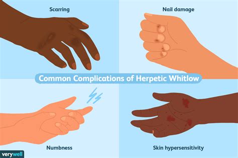 Herpetic Whitlow Symptoms, Causes and Treatment