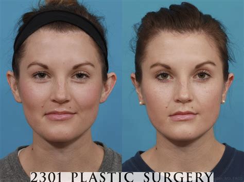 Ear Surgery Otoplasty for Fort Worth & Plano, TX | 2301 Plastic Surgery