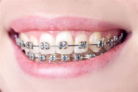 Traditional Dental Braces vs Invisalign Aligners - Consumer Guide to Dentistry