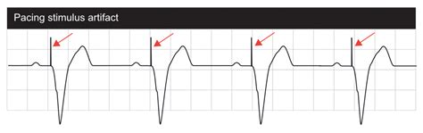 Interpretation of Pacemaker ECG – Cardiovascular Education