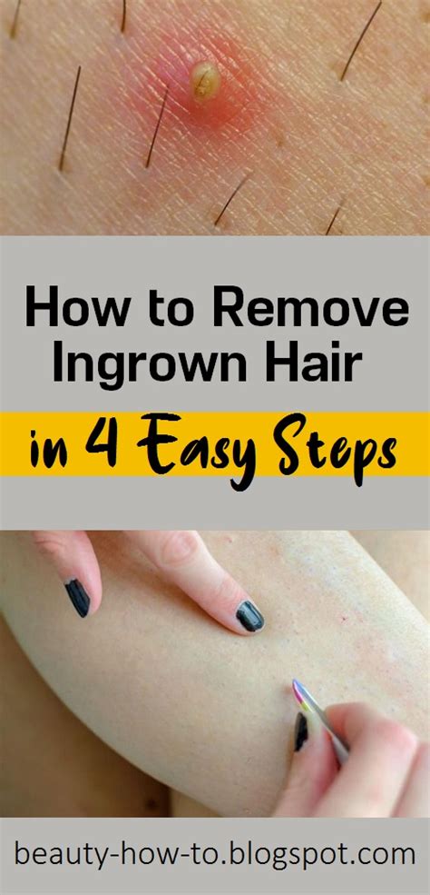 How to Remove Ingrown Hair in 4 Easy Steps - How To Beauty