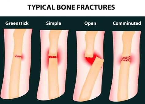 Soorten bot fracturen medische educatieve vector — Stockvector ...