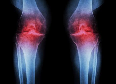 What is Osteoarthritis and its causes | Lifeforce Hub