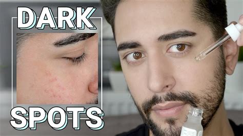 How To Remove Dark Spots On Face Professionally - HOWTOREMVO