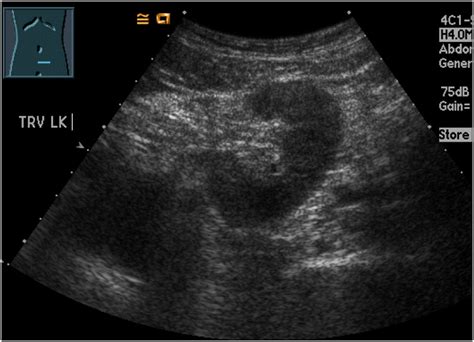 Pictorial review: Renal ultrasound - Clinical Imaging