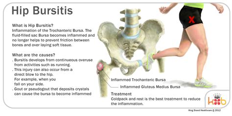 Hip labral tear famous athletes wtp, sleeping after eating during pregnancy, bursitis symptoms ...