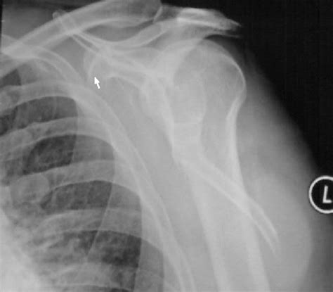 An unusual fracture of the scapular body | Emergency Medicine Journal