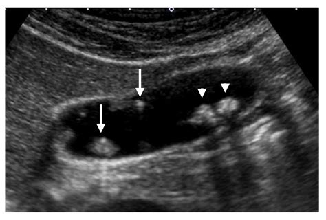 Gallbladder Ultrasound