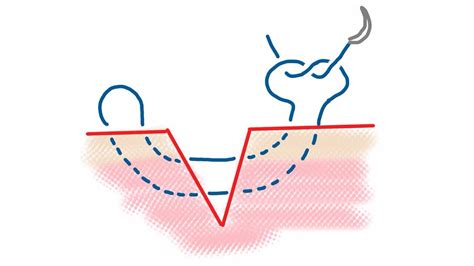 Mattress: Vertical Mattress Suture