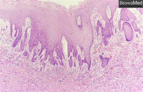 Granular cell tumor