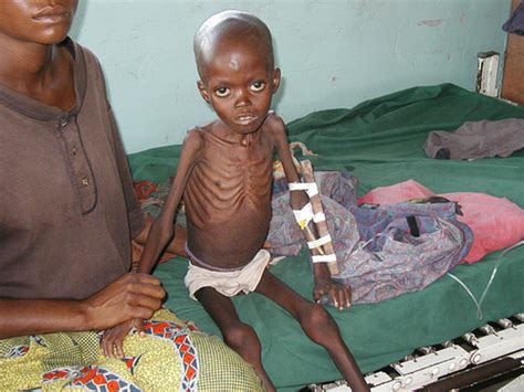 Protein- Energy Malnutrition: Marasmus And Kwashiokor, Clinical Presentations, Pathology And ...