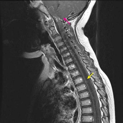 Syrinx of the Spinal Cord or Brain Stem - Neurologic Disorders - Merck ...